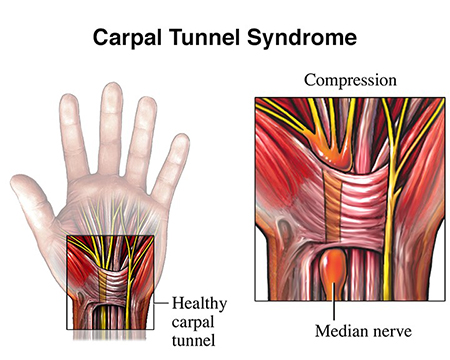 Carpal Tunnel Syndrome diagram