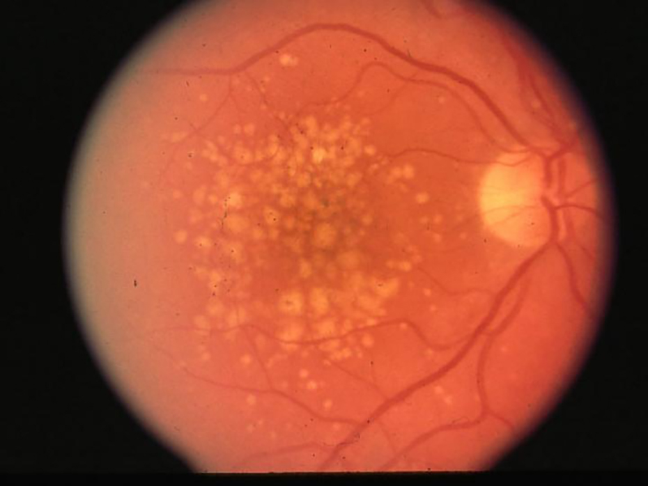 Drusen are tiny yellow deposits under your retina, and may increase risk of macular degeneration.