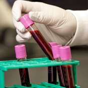 Investigational blood test could detect many types of cancer with one blood draw