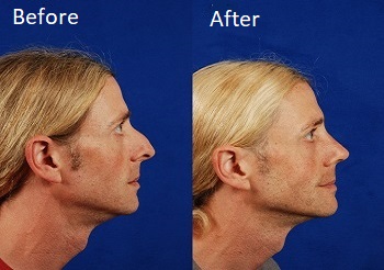 Profile facing image of rhinoplasty before and after - male