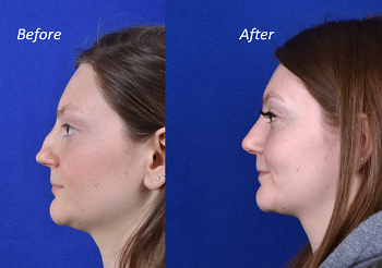 Profile facing image of rhinoplasty before and after - female