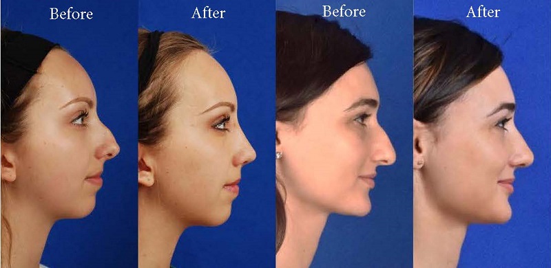 Profile facing images of rhinoplasty before and after - two women