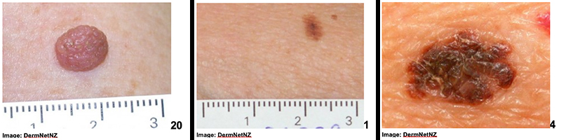 Comparison of skin lesions next to each other