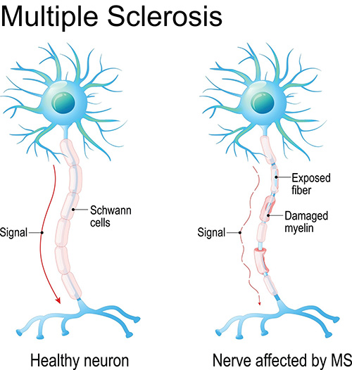 Diagram of cells with multiple sclerosis