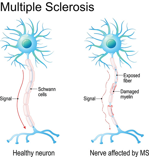 Understanding Multiple Sclerosis Brain Institute Ohsu