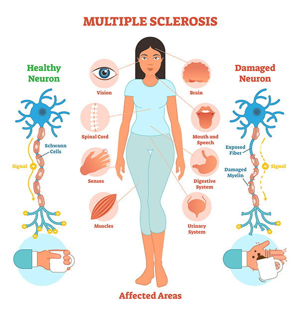 Diagram of MS, Multiple Sclerosis