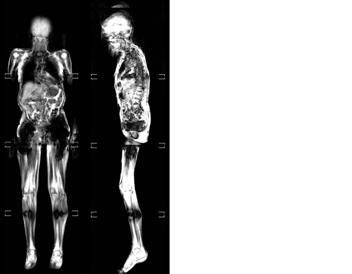 MRI - full body image example for technologists