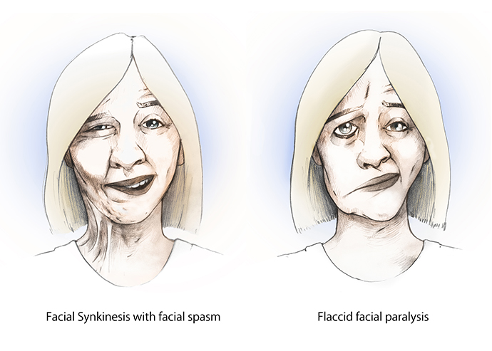 Flaccid and synkinesis paralysis examples