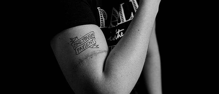 A black and white image of a melanoma survivor with her scar