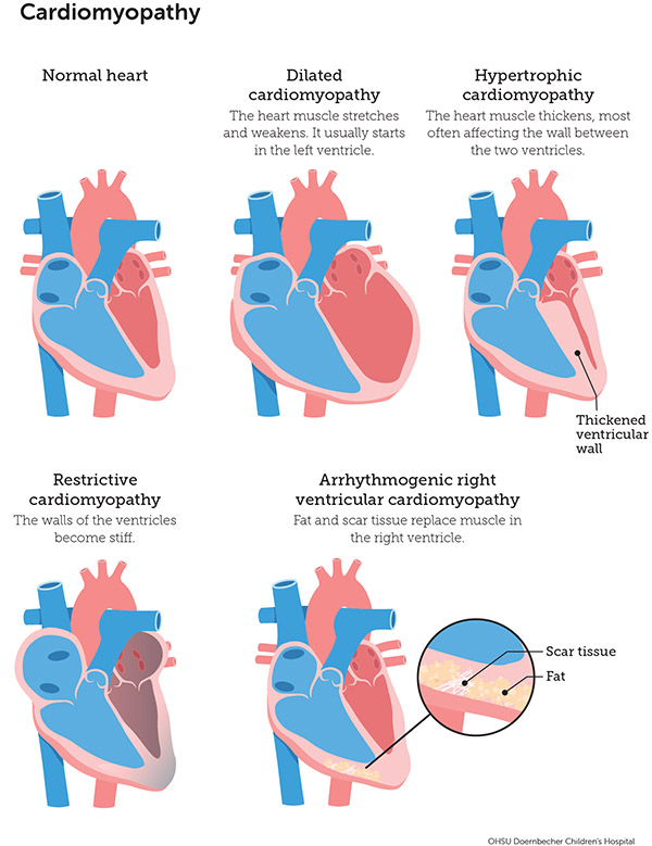 A diagram of different types of cardiomyopathy, compared to a normal heart.