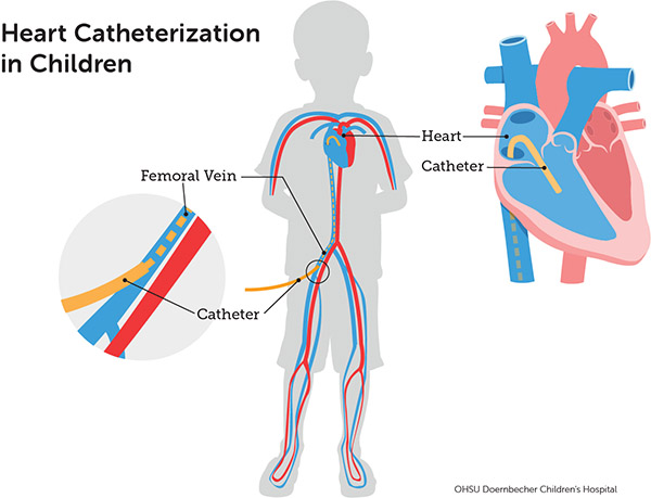 Diagram of heart catheterization in children