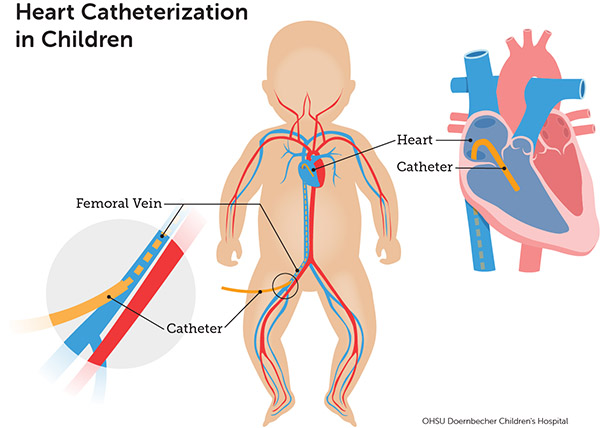Diagram of heart catheterization in infants
