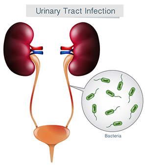 A diagram depicting kidneys with a urinary tract infection.