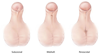 A diagram showing Hypospadias at various points on a child penis.