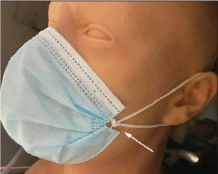 Photo of a disposable mask on a model; there is a knot tied in the ear loops to make the mask fit snug over the face.