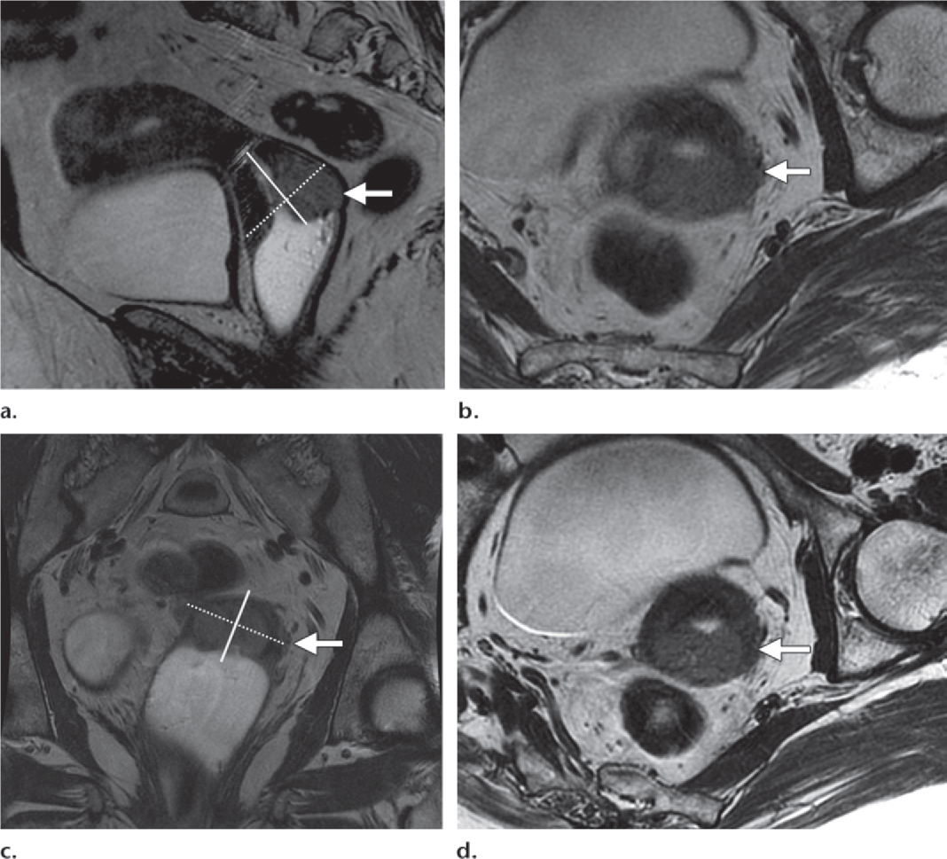 Example image for MRI Techs to utilize for planning sequence angulation and coverage for Brachytherapy exams