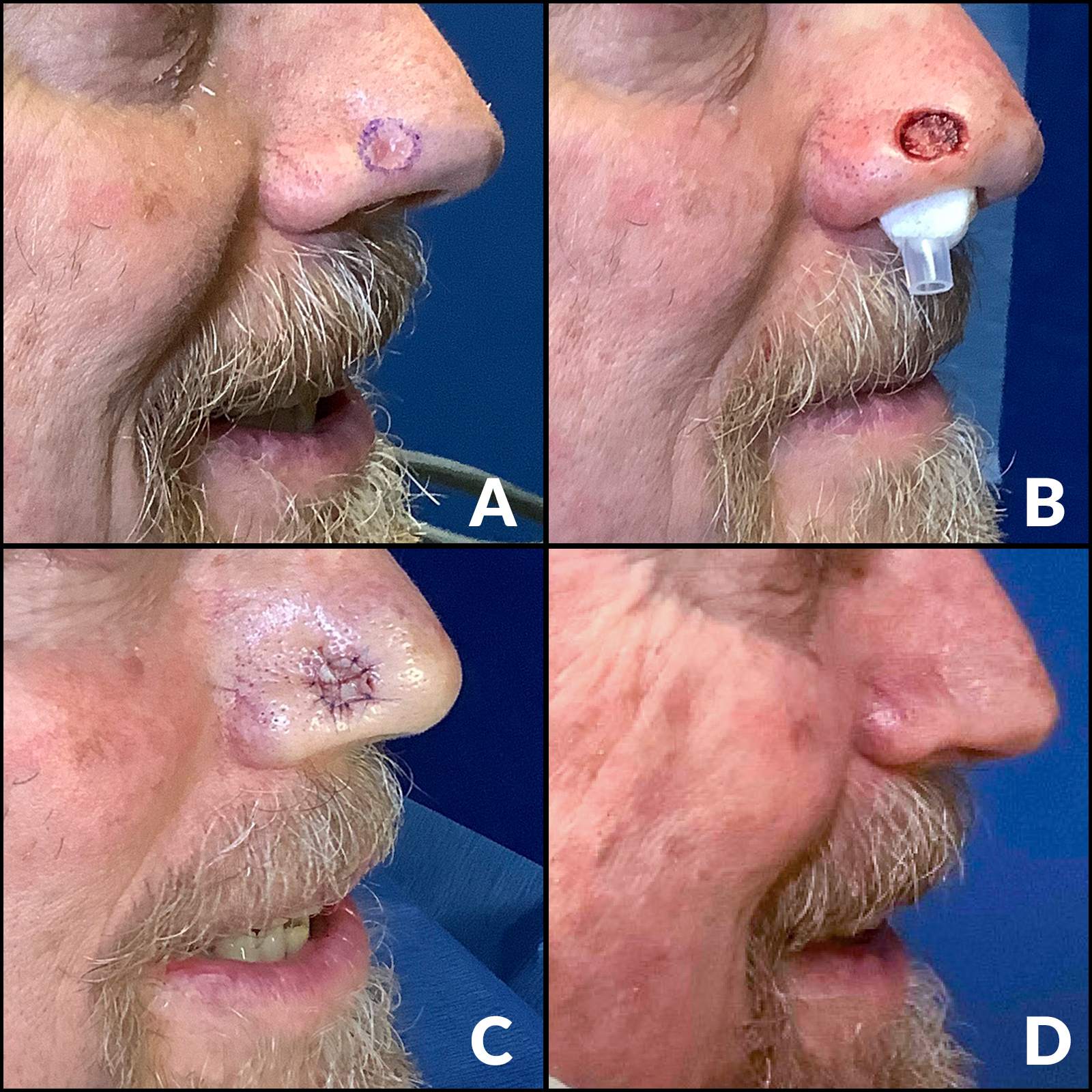 A comparison collage of images for a Mohs surgery patient