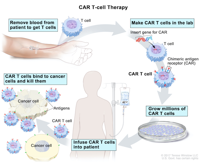 Diagram of the process of CAR T-cell therapy