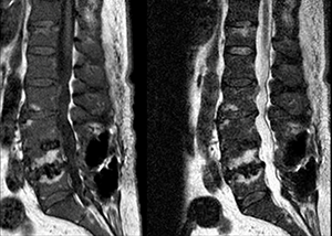 Two MRI views of a spine