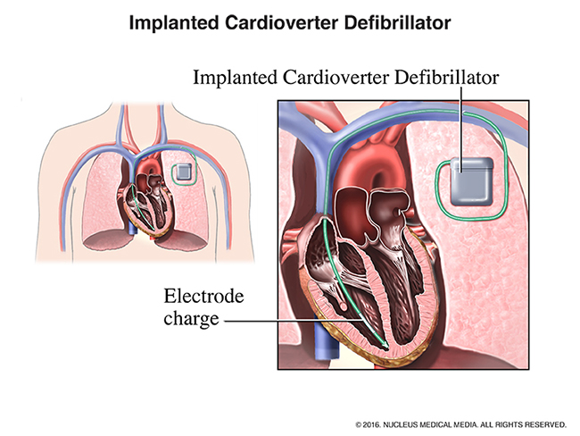 A diagram illustrating an implanted cardioverter defibrillator in a human chest.