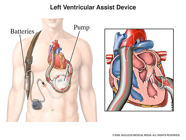 A diagram illustrating a left ventricular assist device in a human chest.