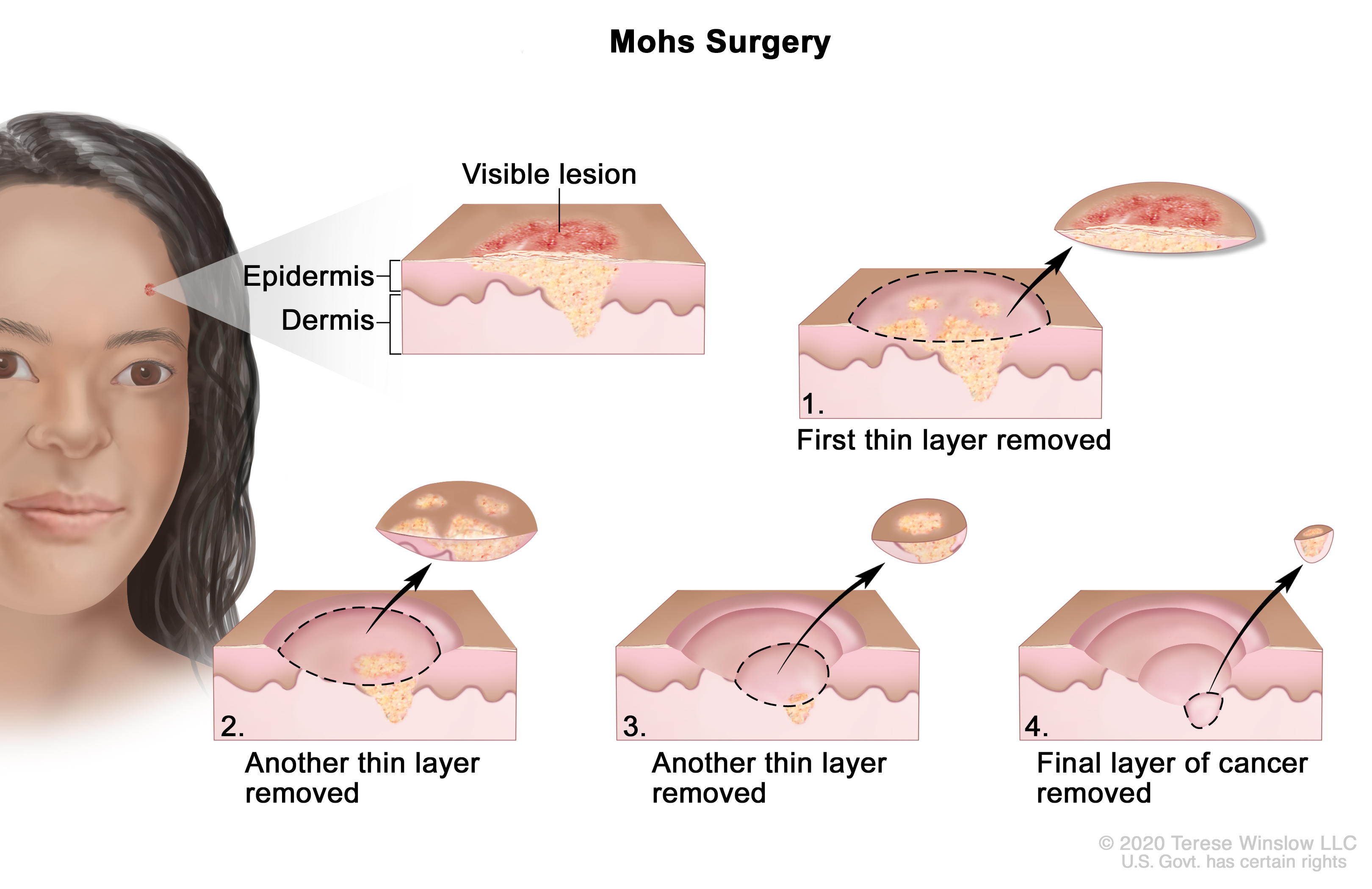 A diagram illustrating the phases of the Mohs surgery procedure.