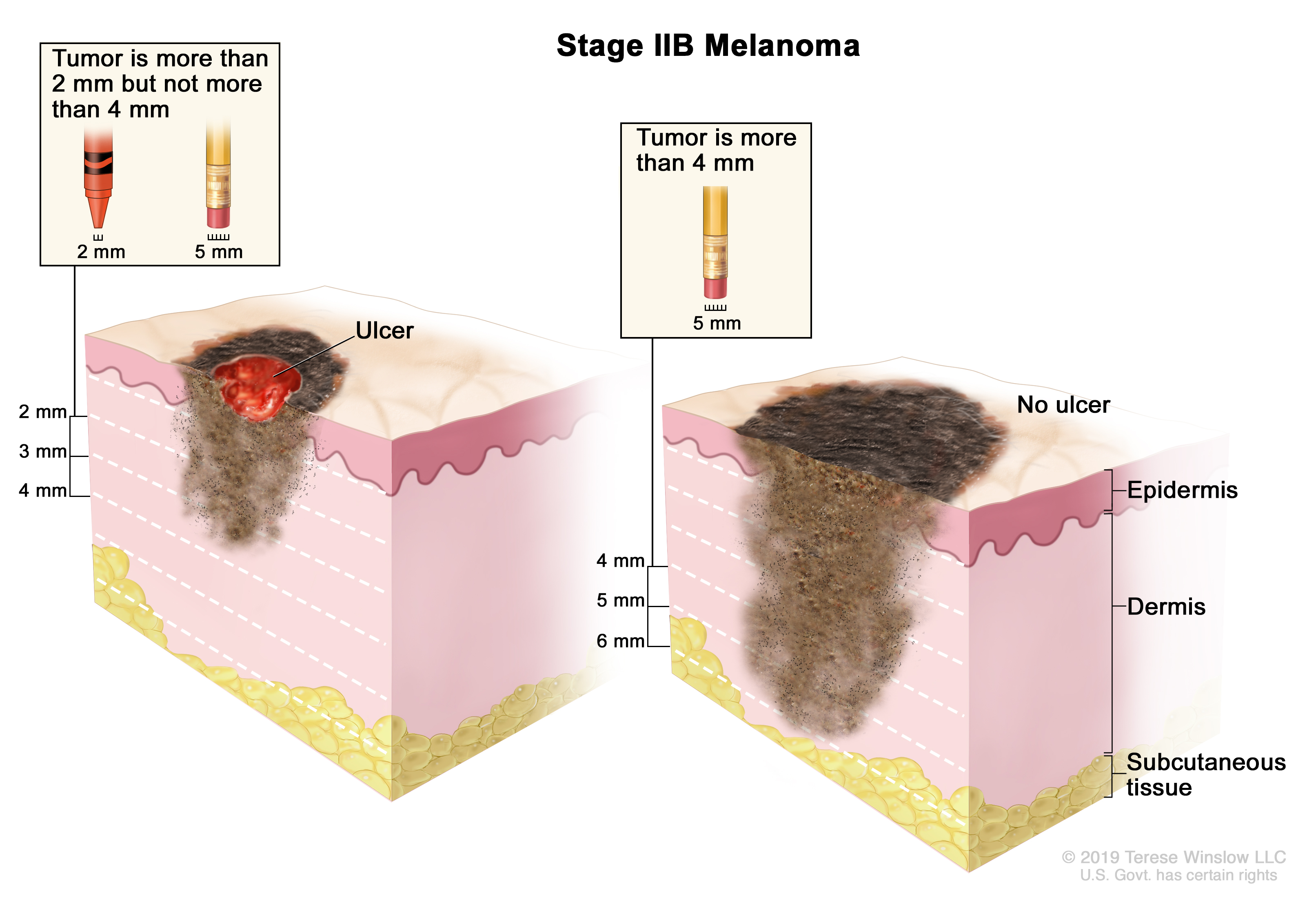 A diagram illustrating Stage II melanomas.
