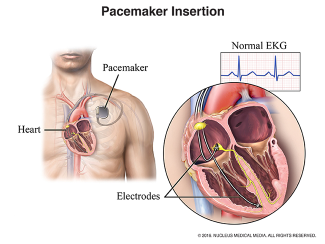 A diagram illustrating a pacemaker inserted into a human chest.