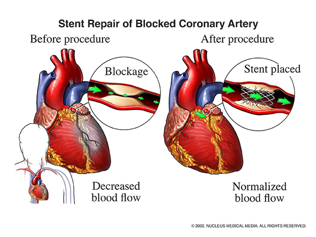 A diagram illustrating a stent repair of a blocked coronary artery within the human heart.