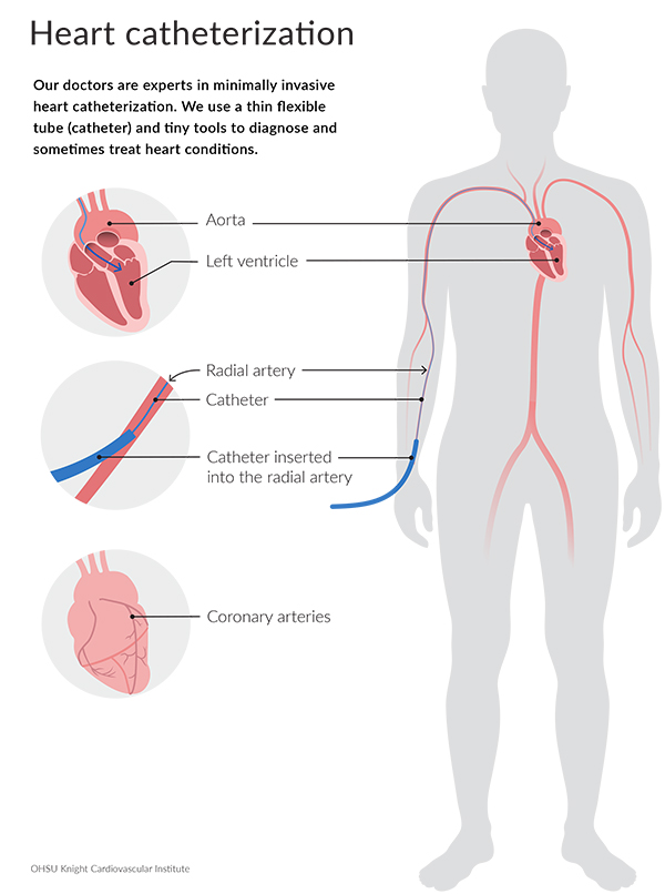 Diagram of the heart catheterization process with zoomed in images of the aorta, radial artery with catheter and coronary arteries