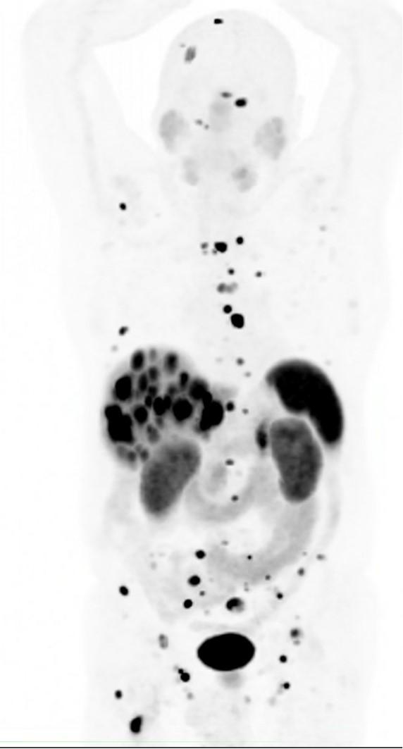 Diagnostic Radiology PET PACS DOTATATE Image used for neuroendocrine tumors.