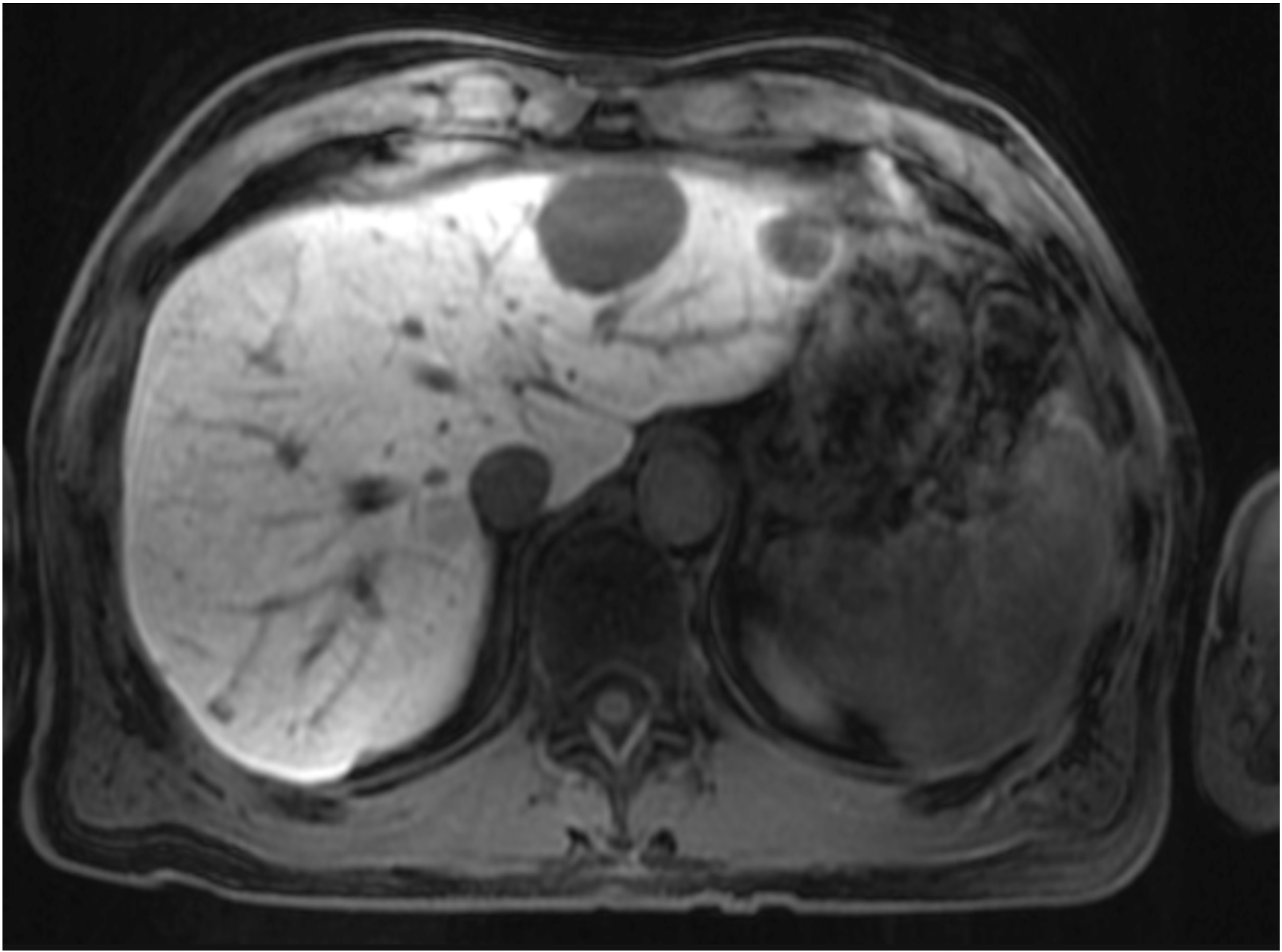 Diagnostic Radiology MRI PACS Image of the liver with hepatobiliary-specific contrast agent to allow for accurate evaluation of metastatic liver lesions.