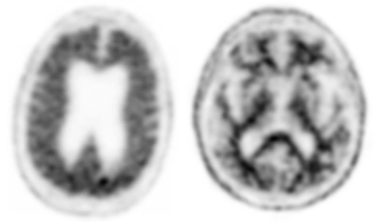 Diagnostic Radiology Positive (left) vs. Negative (right) PET PACS Amyloid Image used for Alzheimer's disease.