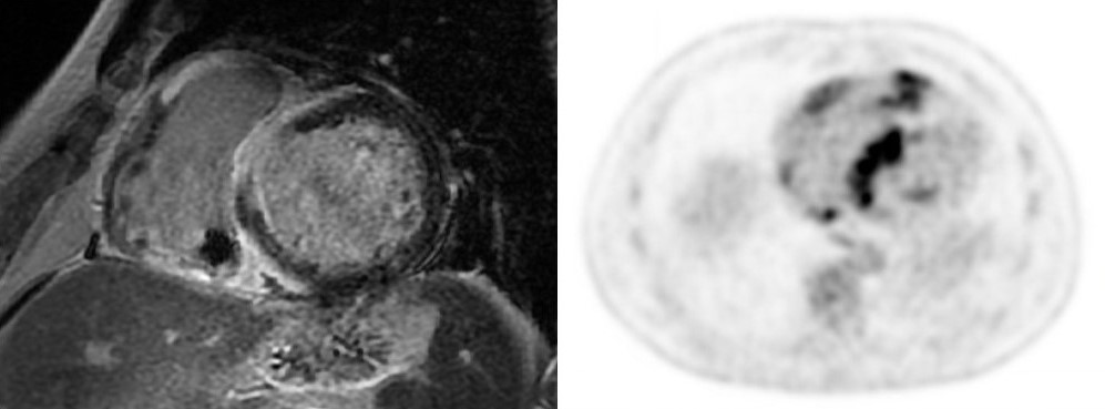 Diagnostic Radiology MRI and PET PACS images of Cardiac Sarcoidosis