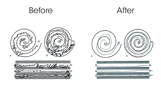 Two spiral drawings shown side-by-side, one before a focused ultrasound treatment and one after, illustrating improvement with less scribbles.