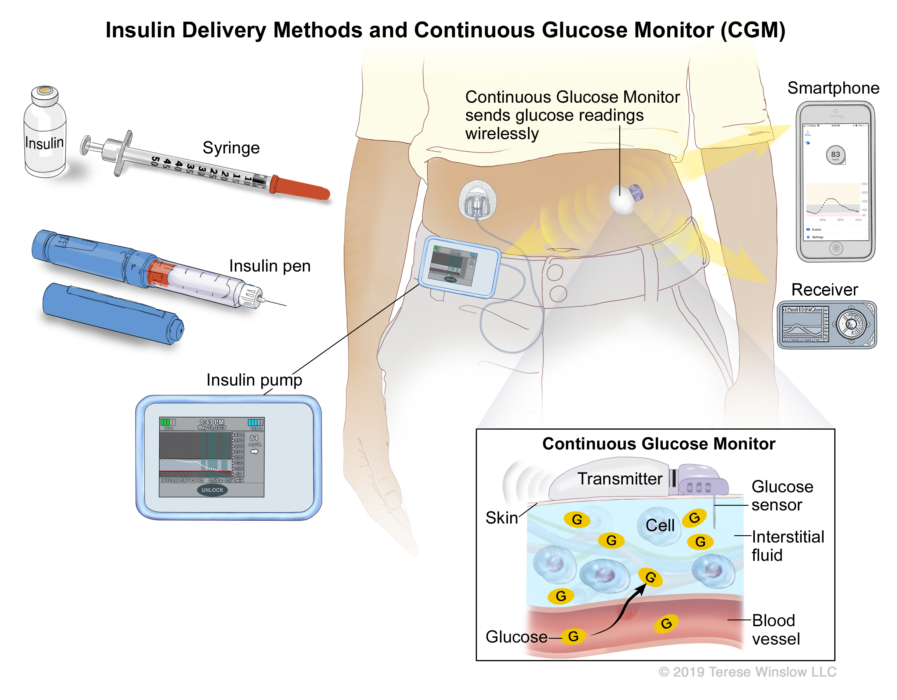 Medical illustration of insulin delivery methods and continous glucose monitoring