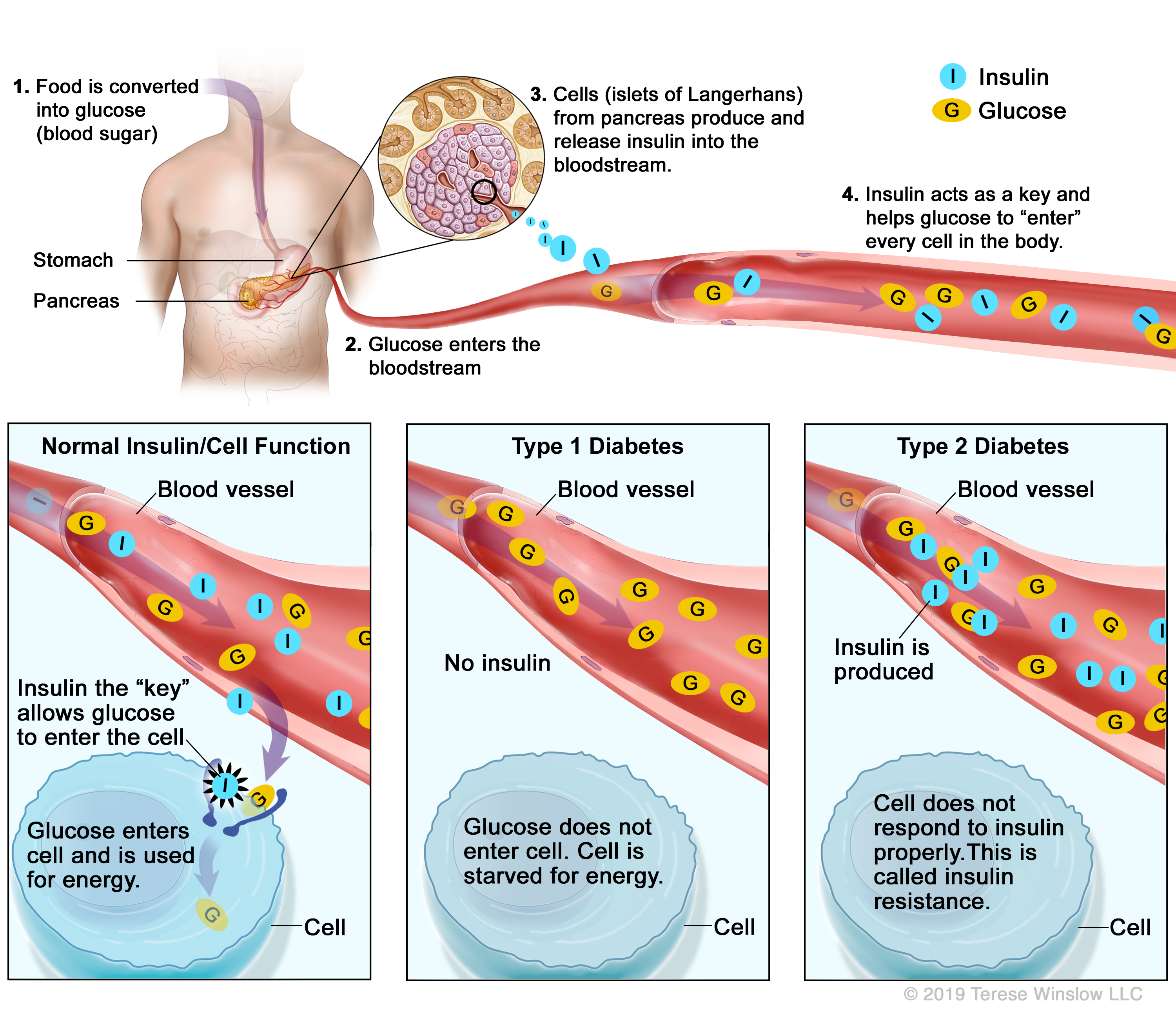 Visual medical illustration describing type 1 diabetes and type 2 diabetes versus normal cell function