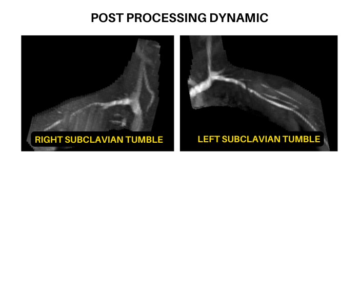 Post Processing Left and Right Subclavians for vascular access MRI protocol
