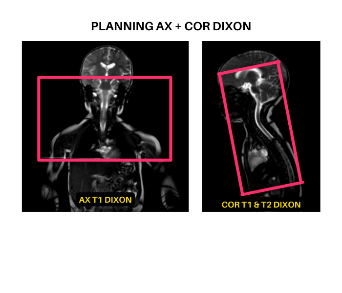 Planning AX and COR T1 Dixon sequences for vascular access MRI protocol