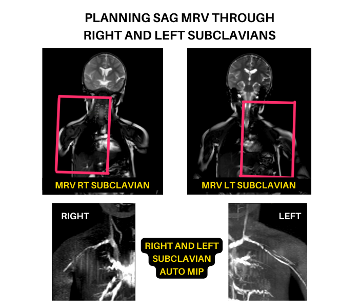 Planning SAG Subclavian MRV sequence for vascular access MRI protocol