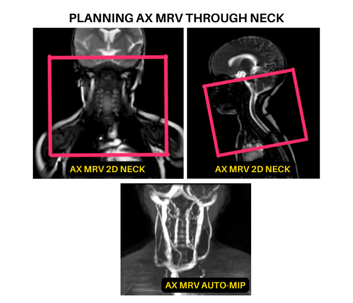 Planning AX Neck MRV sequence for vascular access MRI protocol