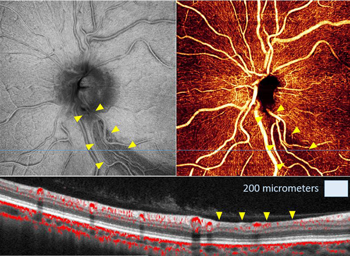 Series of images of a glaucoma patient's eye using OCT technology.