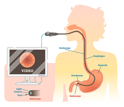 A diagram illustrating a endoscopy inserted through the mouth and down into the stomach.