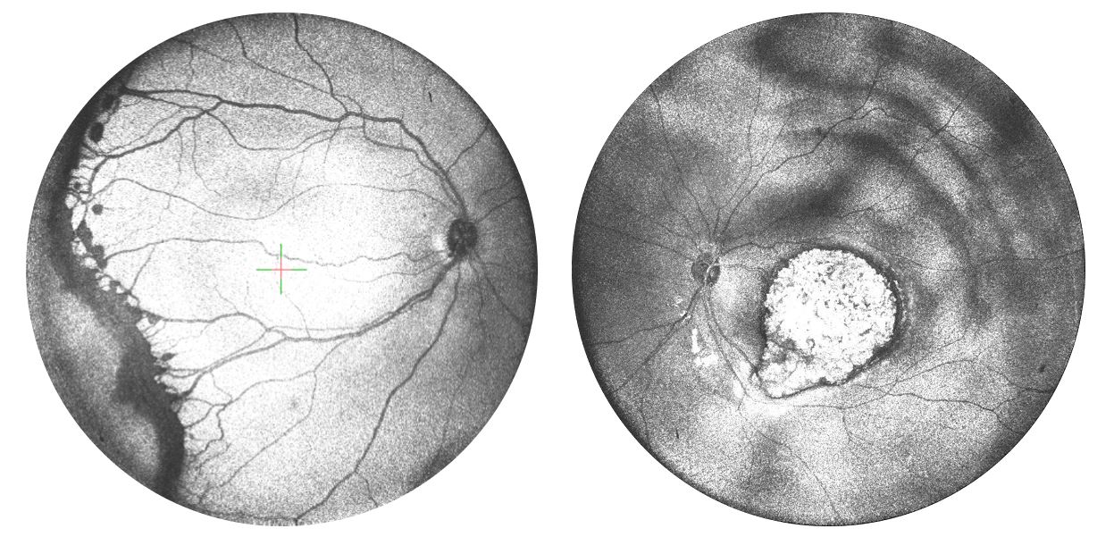 Retinal images taken using a new OCTA device of ROP and retinoblastoma