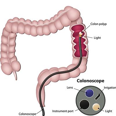 A diagram illustrating a colonoscope inserted into the large intestine.