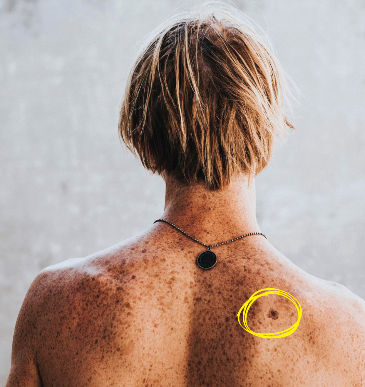 A man with many spots on his back has a mole circled to indicate something potentially harmful