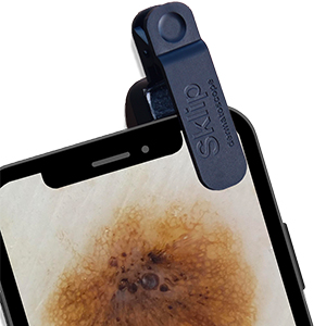 A phone with a Sklip device taking a photo of a mole
