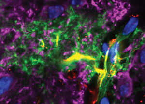 An astrocyte contacting a cortical capillary. The astrocyte is labelled with a genetically expressed green fluorescent protein - green - and immunolabeled for glial fibrillary acidic protein - red - with overlap shown in yellow. neurons are immunolabelled for microtubule associated protein - magenta. Nuclei are marked with DAPI - blue. The endfeet of the astrocyte demarcate the capillary.