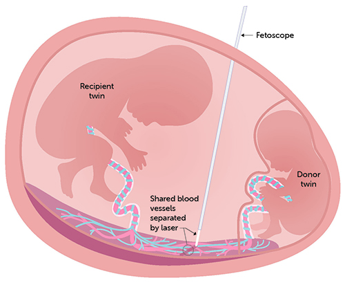A diagram of a placenta being shared by twins with a fetoscope inserted between them.