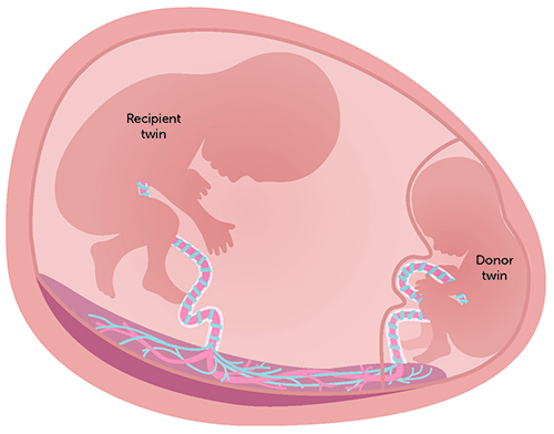 A diagram of a placenta being shared by twins.
